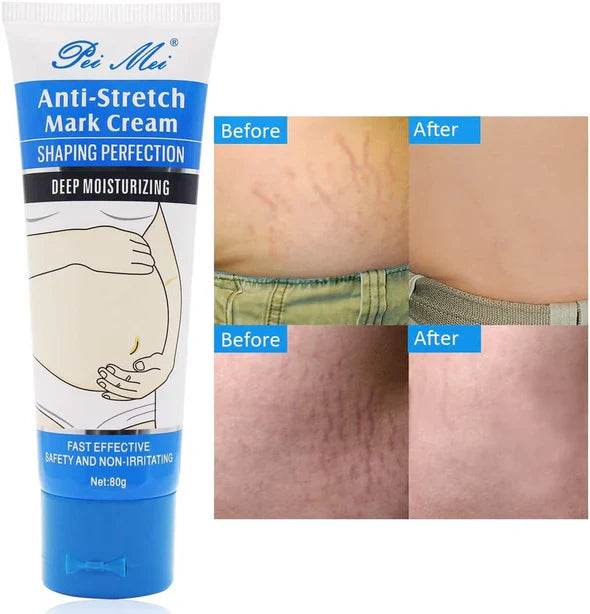 Stretch Mark Remover Anti Stretch Mark Cream 80gm 👌